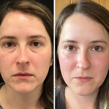 InstantGlow Collagen Eye Patches