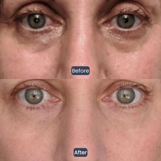 Collagen-Infused Tightening Eye Patches